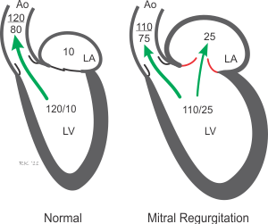 mitral regurgitation cardiac chamber pressures